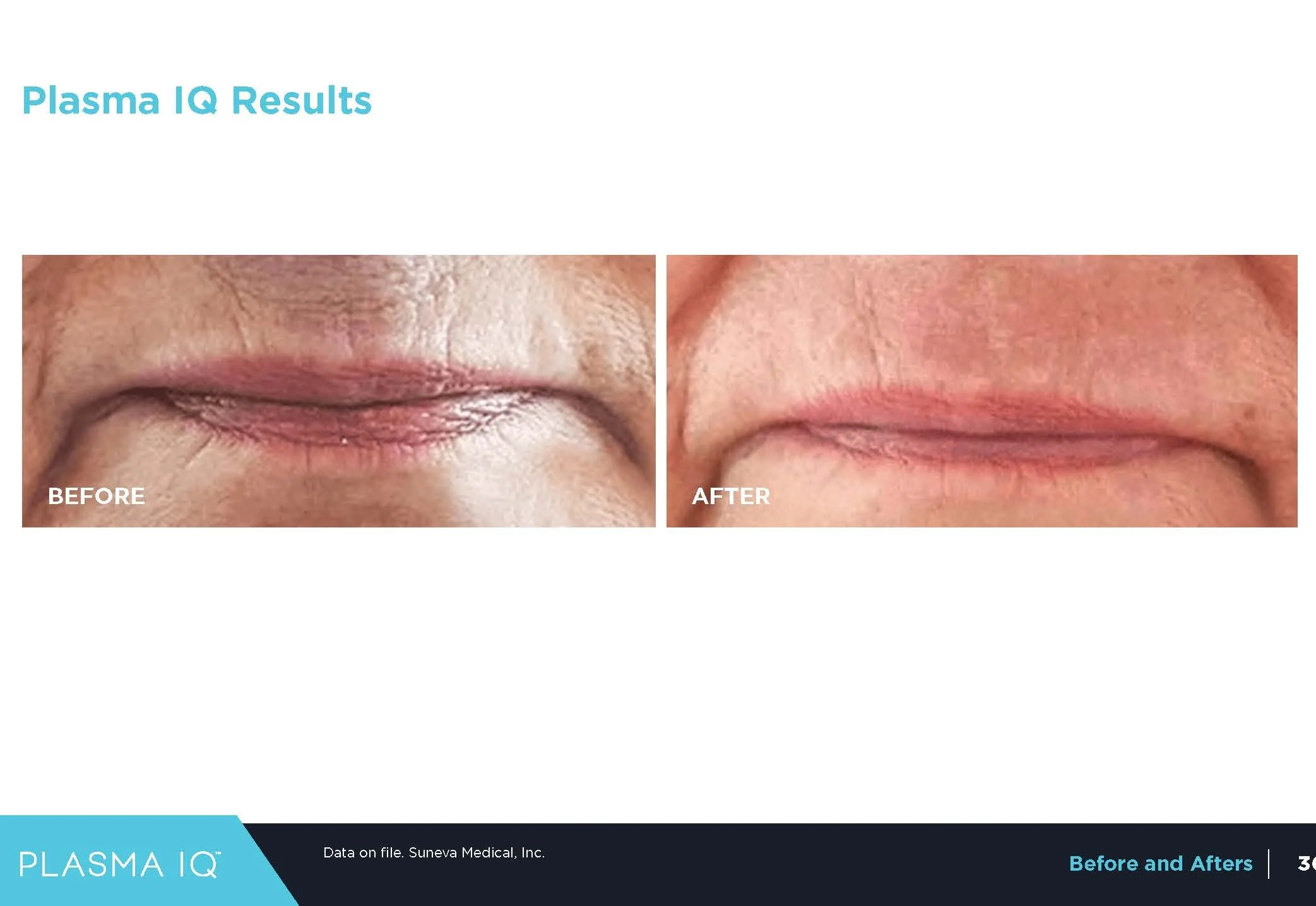 Plasma IQ treatment for lip lines and perioral wrinkles before and after results. OpalGlow Medspa, Woodbridge, NJ.