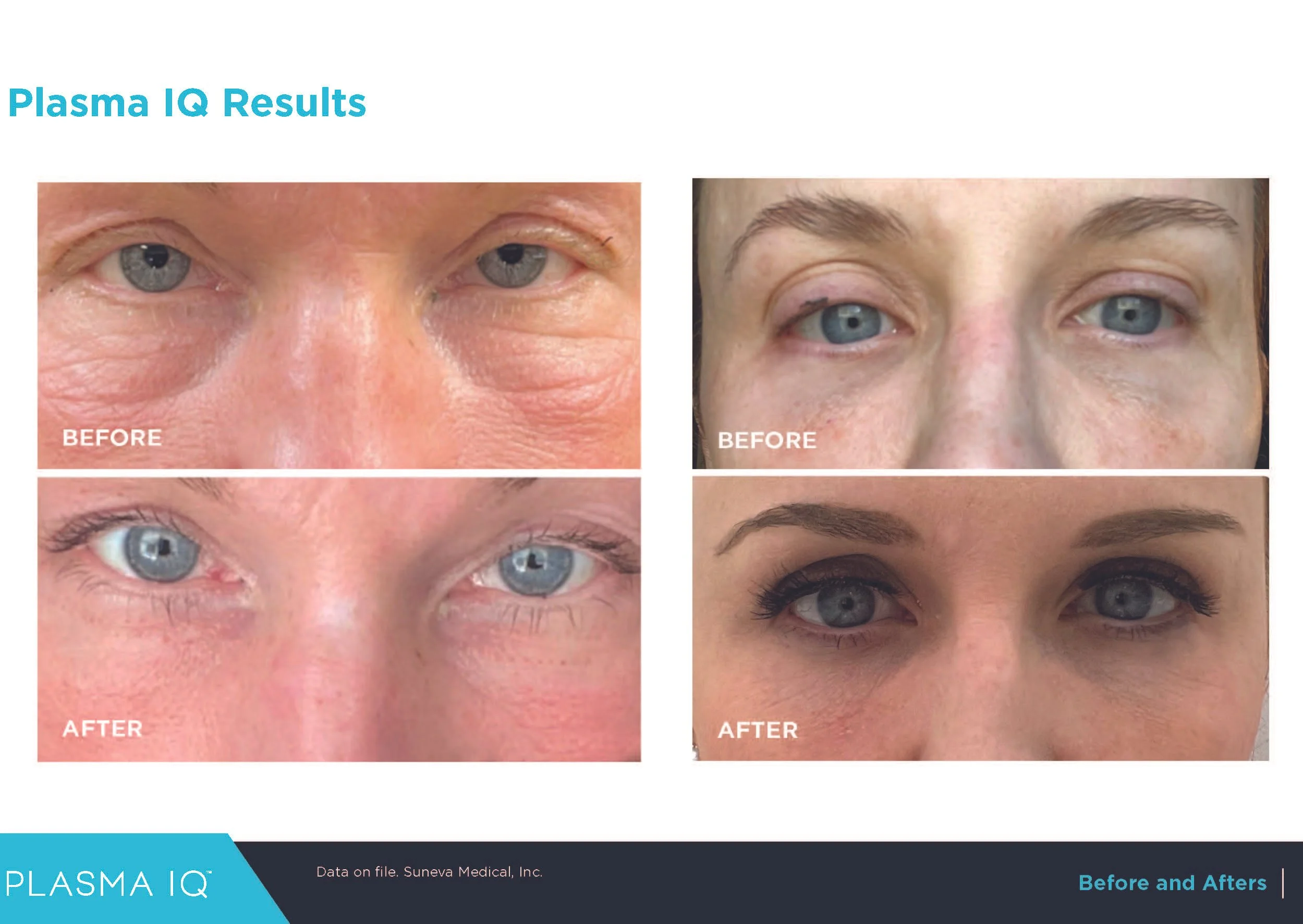 Plasma IQ eye rejuvenation treatment before and after tightening upper and lower eyelid skin