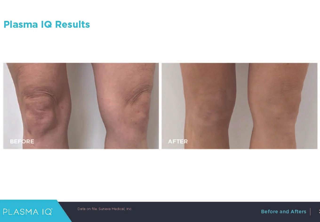Plasma IQ skin tightening treatment for loose skin around the knees before and after. OpalGlow Medspa. Woodbridge, NJ.