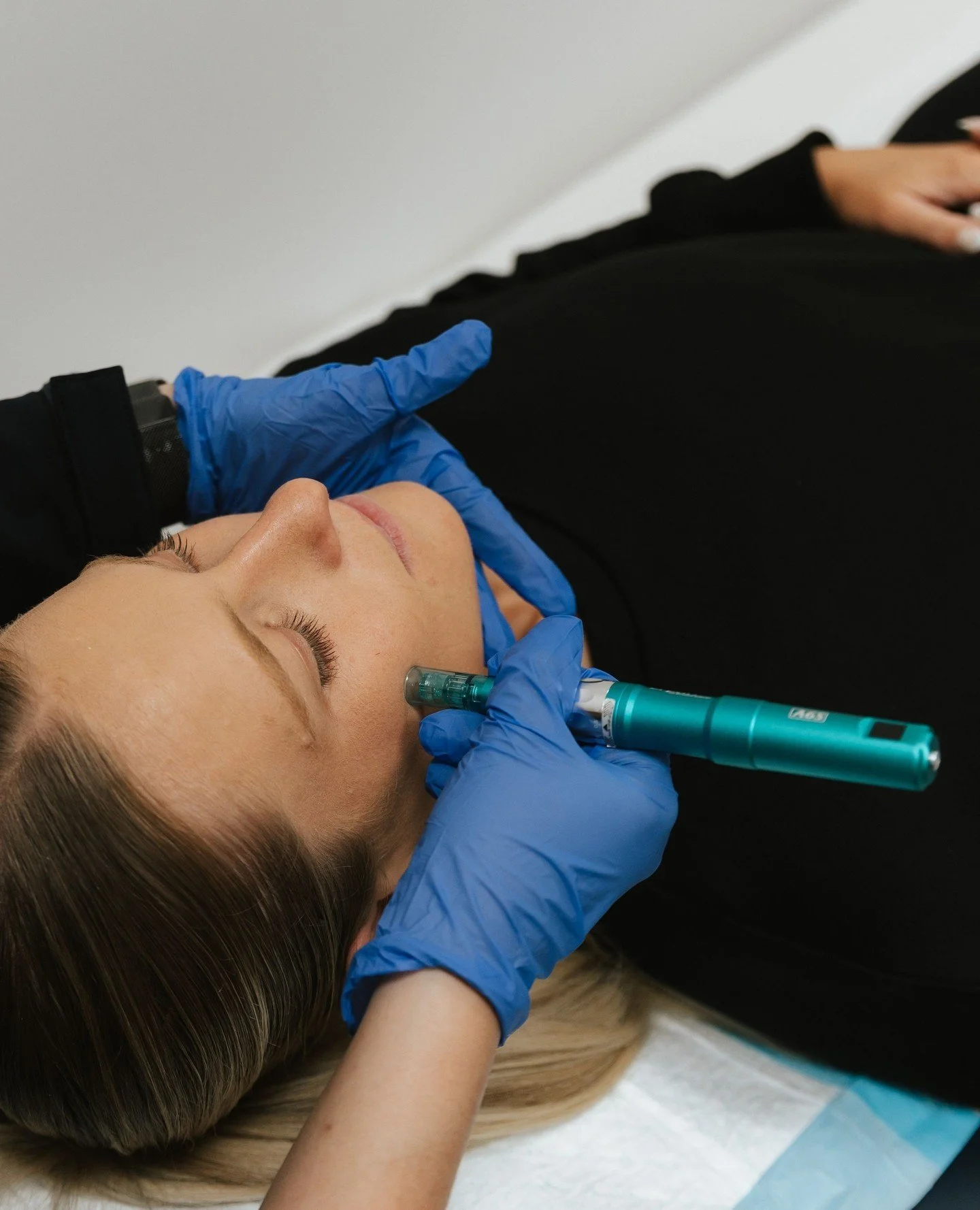 What is microneedling?⁠
⁠
Microneedling uses a pen-like device with fine needles that create tiny, controlled micro-injuries in the skin. This triggers your skin&rsquo;s natural repair response and boosts collagen production, helping improve texture,
