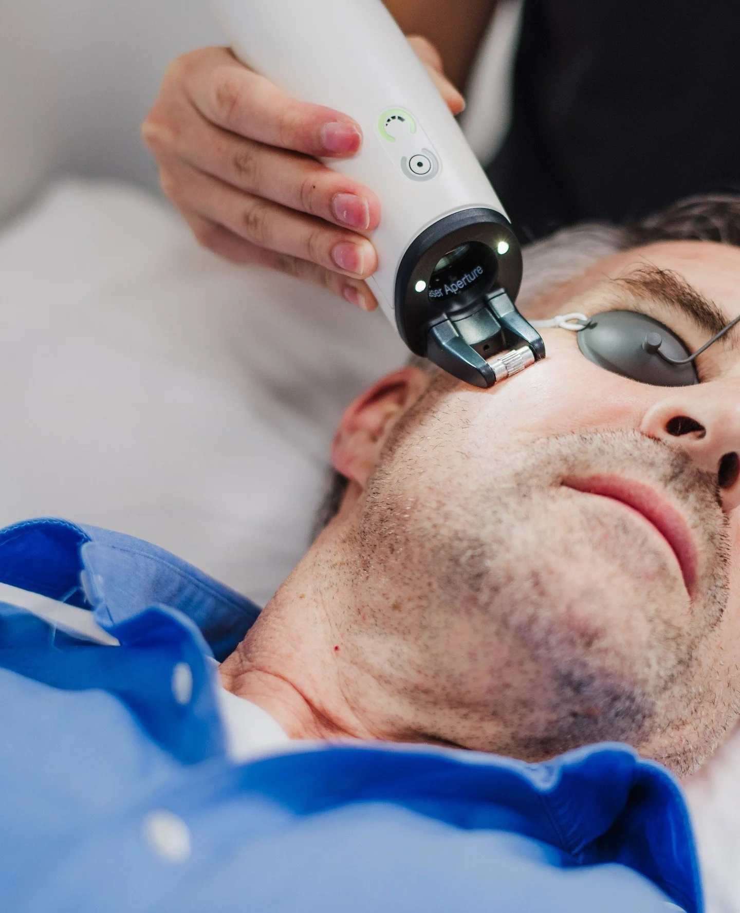 Sun damage and age spots can result from a range of factors, including sun exposure and the natural ageing process. ⁠
⁠
At The Cosmetic Clinic, our medical-grade laser treatments can be used to reduce unwanted blemishes and get your skin back to your