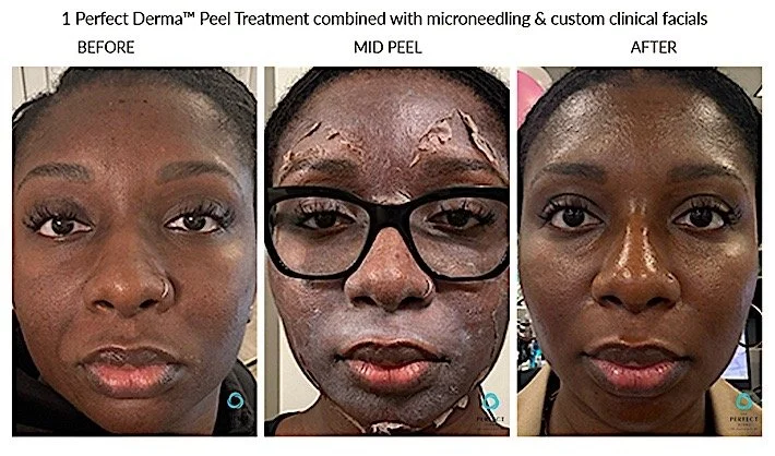 What Is The Perfect Peel? Everything You Need to Know Before Booking