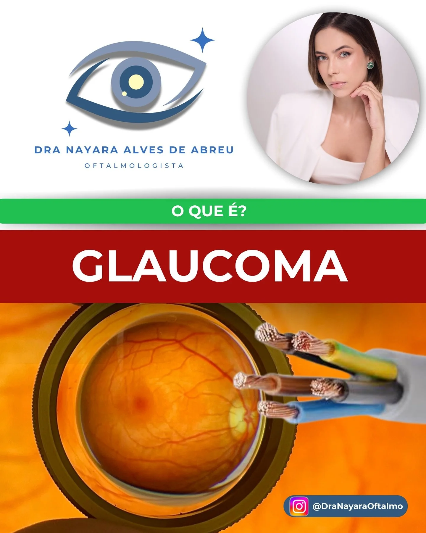 👁️&zwj;🗨️ Voc&ecirc; sabe o que &eacute; o glaucoma?

Imagine que o nervo &oacute;ptico &eacute; como um cabo de energia que leva as informa&ccedil;&otilde;es visuais do olho at&eacute; o seu c&eacute;rebro.
Agora imagine o que acontece quando esse