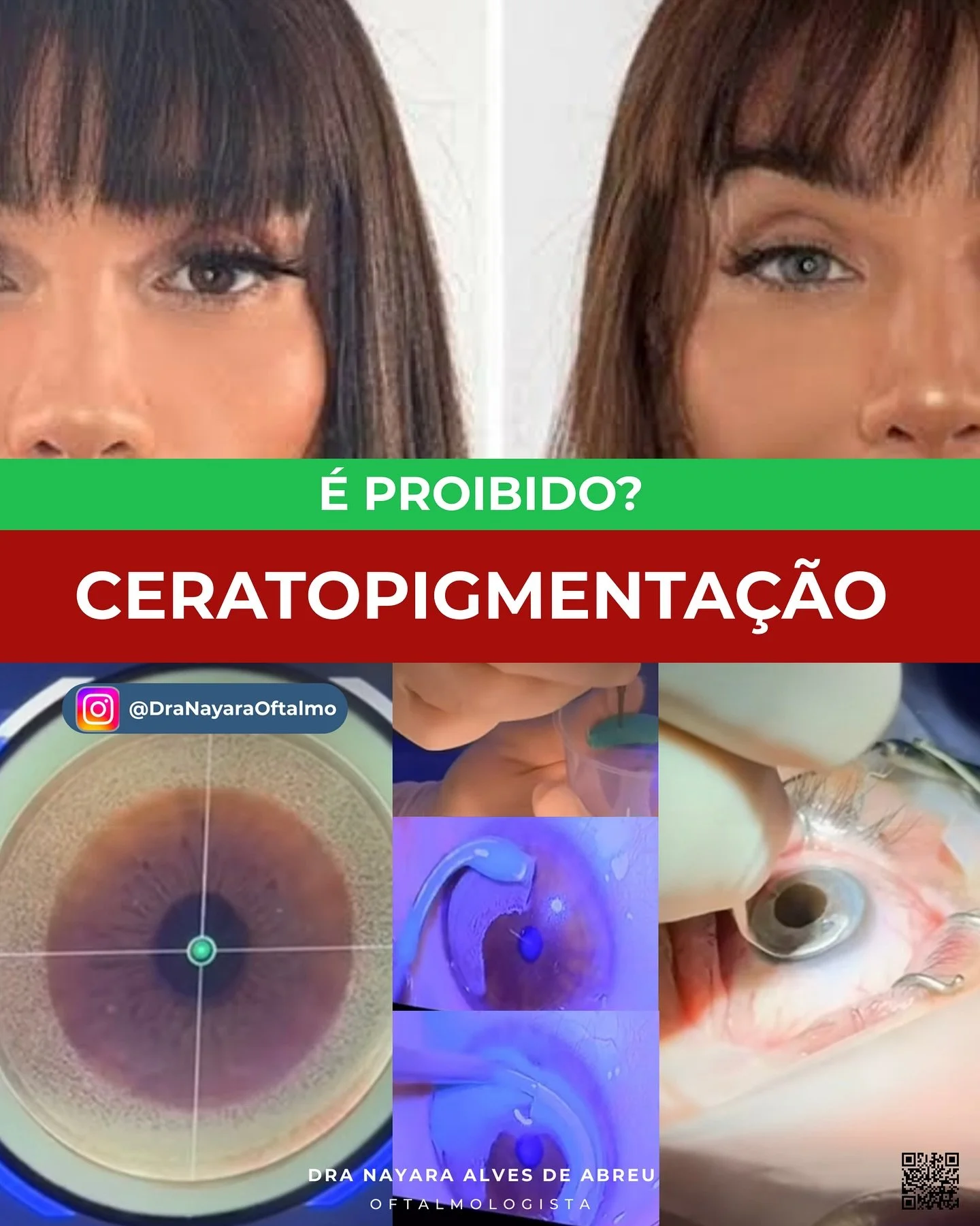 👁 CERATOPIGMENTA&Ccedil;&Atilde;O: &Eacute; PROIBIDO?
Voc&ecirc; j&aacute; viu algu&eacute;m mudar a cor dos olhos de forma definitiva e ficou curioso(a)? 🧐
Ent&atilde;o &eacute; hora de entender o que est&aacute; por tr&aacute;s desse procedimento