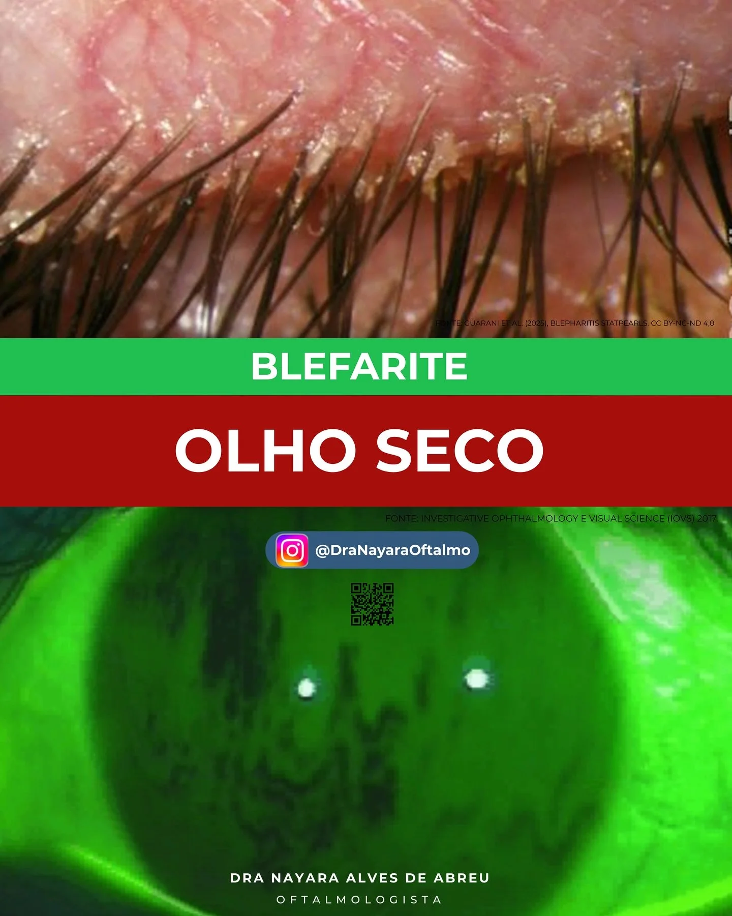 🔬 Voc&ecirc; sabia que a l&aacute;grima &eacute; formada por 3 camadas essenciais?
➡️ Mucosa, aquosa e lip&iacute;dica &mdash; cada uma produzida por diferentes gl&acirc;ndulas do olho!

🧼 Quando ocorre blefarite (inflama&ccedil;&atilde;o com ac&ua