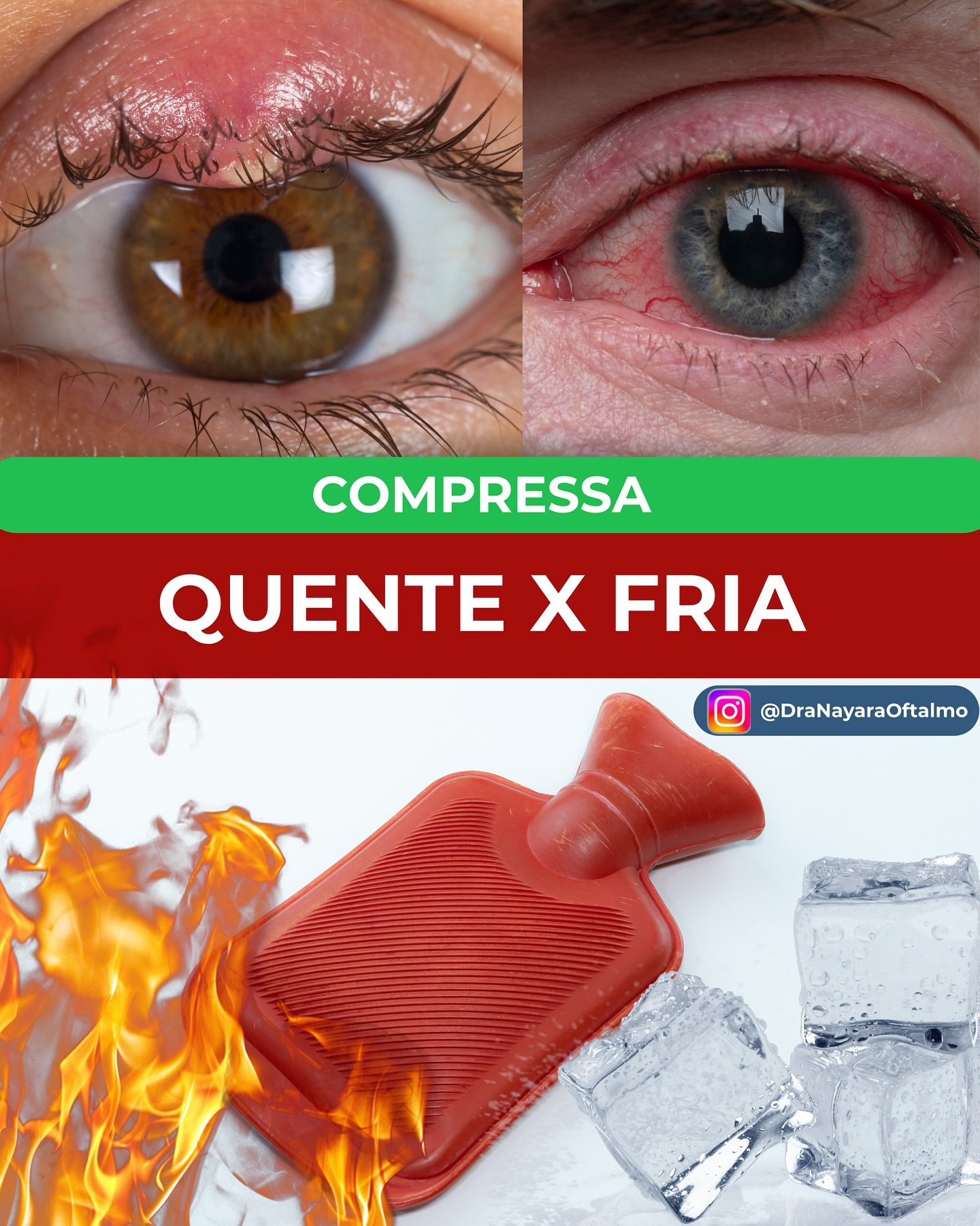 🔸 Compressa quente ou fria? Entenda quando usar cada uma!

👁️&zwj;🗨️ Compressas s&atilde;o &oacute;timas aliadas no cuidado ocular, mas cada tipo tem sua fun&ccedil;&atilde;o espec&iacute;fica:

🔥 Compressa quente (ou morna):

1️⃣ Vasodilata&cced