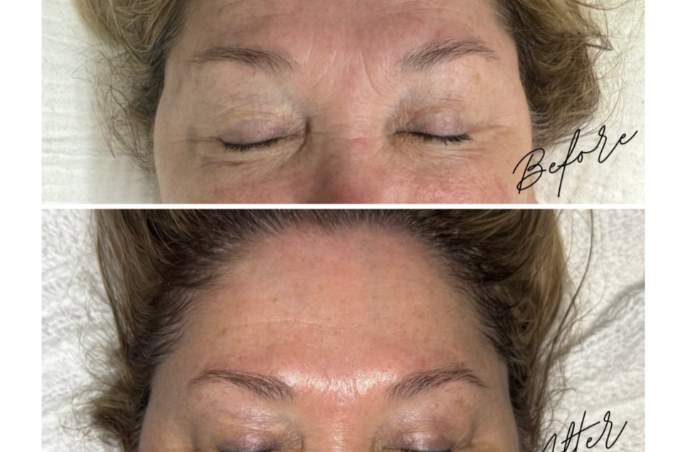3 BOTOX FACIALS + BIO REPEEL + PROCELL