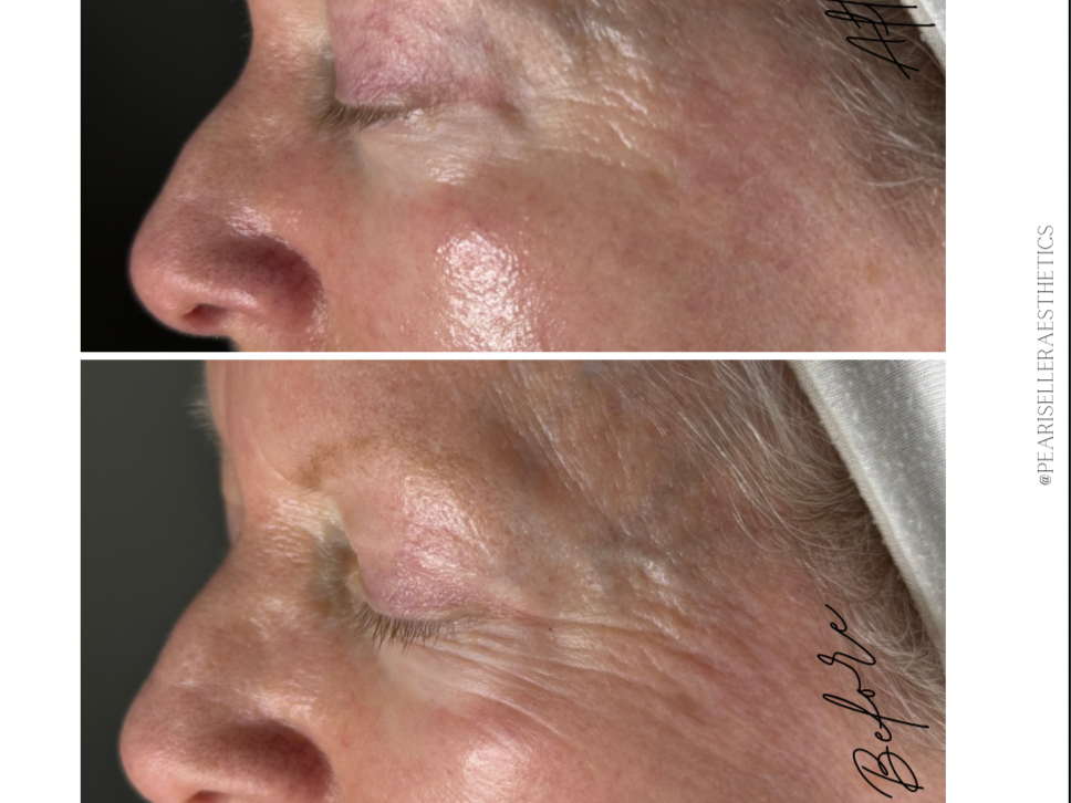 BOTOX IN A BOTTLE TREATMENT