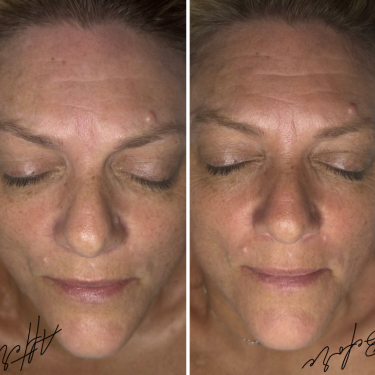 BOTOX IN A BOTTLE TREATMENT