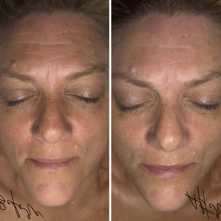 BOTOX IN A BOTTLE TREATMENT