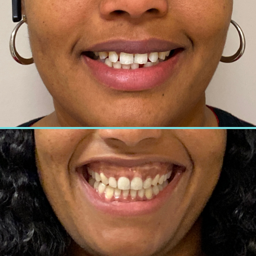 Close-up of Invisalign transformation.