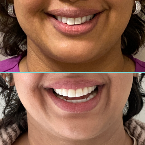 Close-up of a woman's lips and teeth, showing a before and after comparison of dental work.