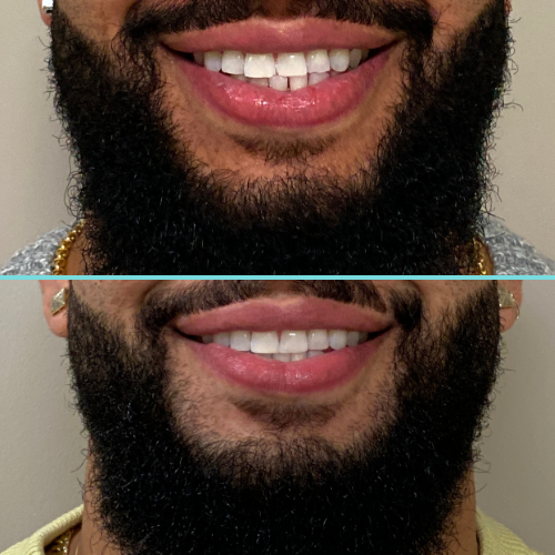 Close-up of a man's smile showing his dental transformation. 