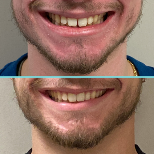 Close-up on Clear Aligner transformation.