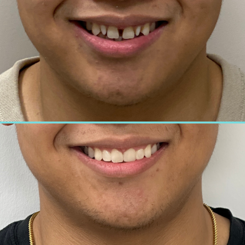 Close-up of a person's smile showing teeth before and after dental improvement.