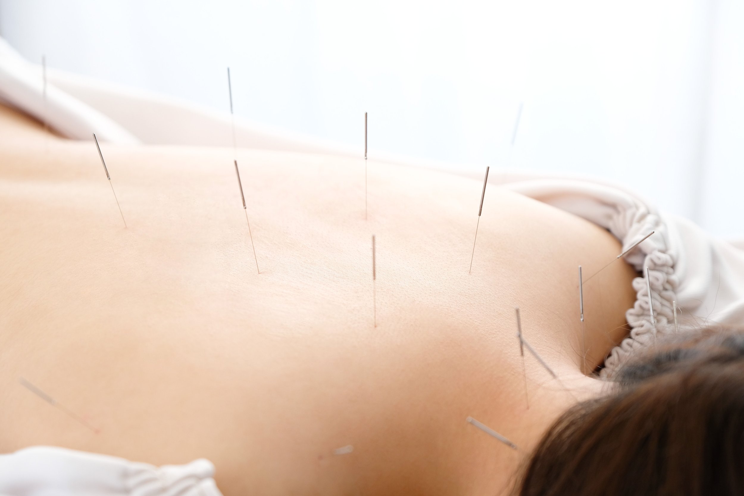 Acupuncture needles inserted into a person's back as part of a therapy session.