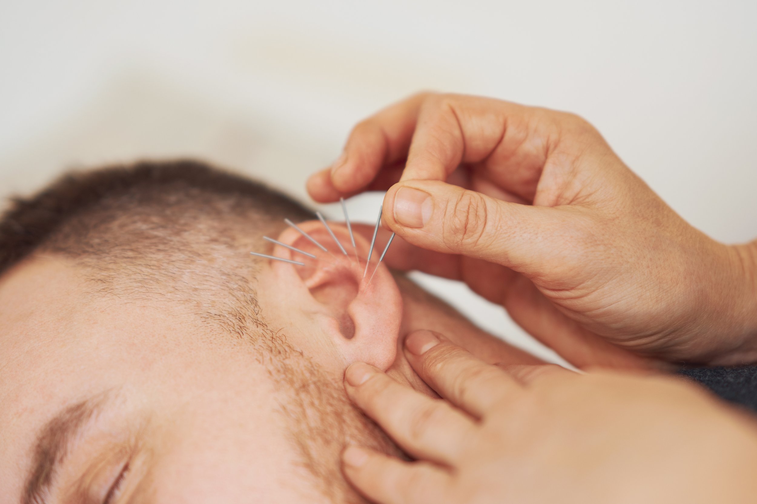 Close-up of an ear acupuncture treatment with several needles inserted.