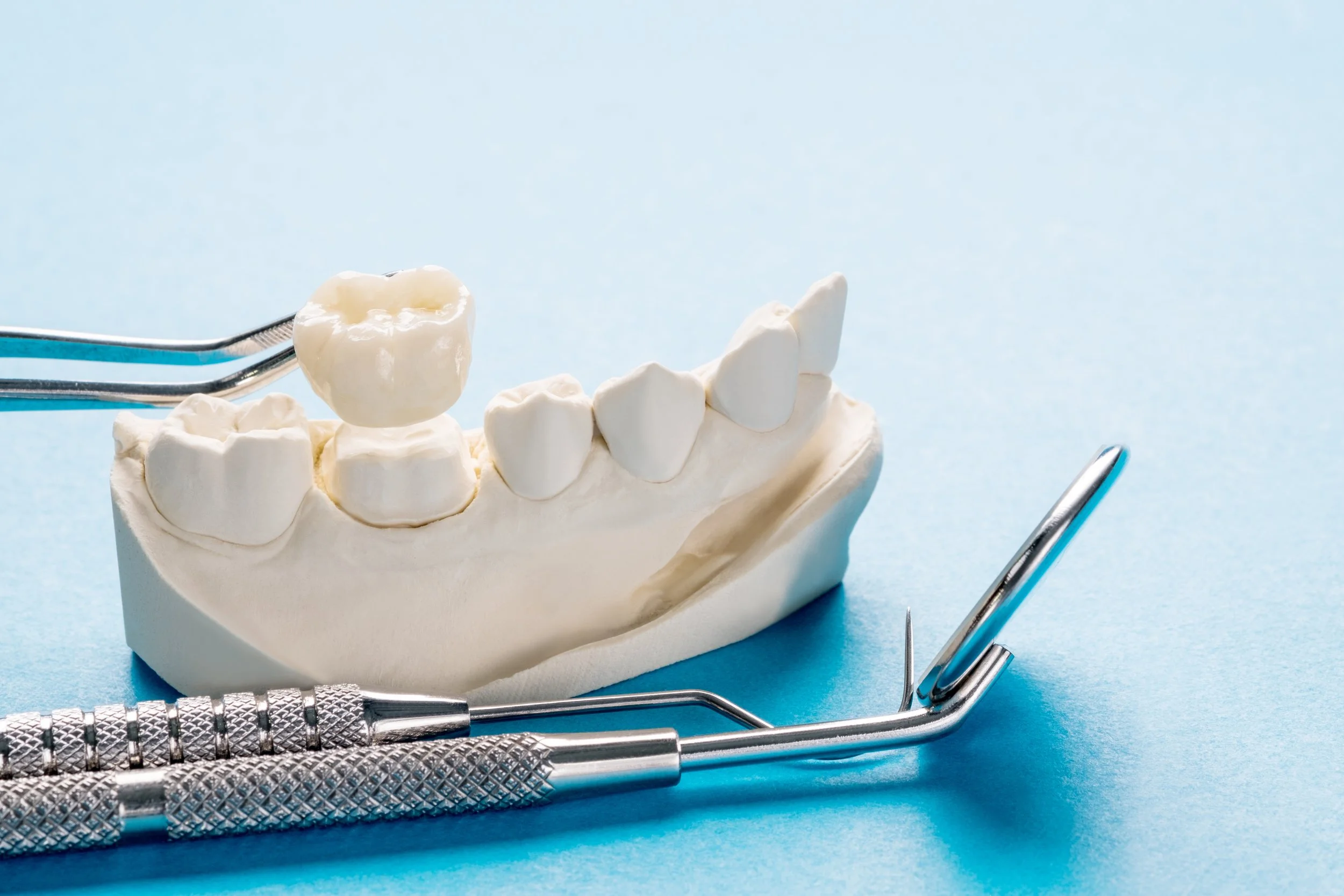 All-on-X with Zirconia Implants: Strength, Aesthetics, and Biocompatibility in One