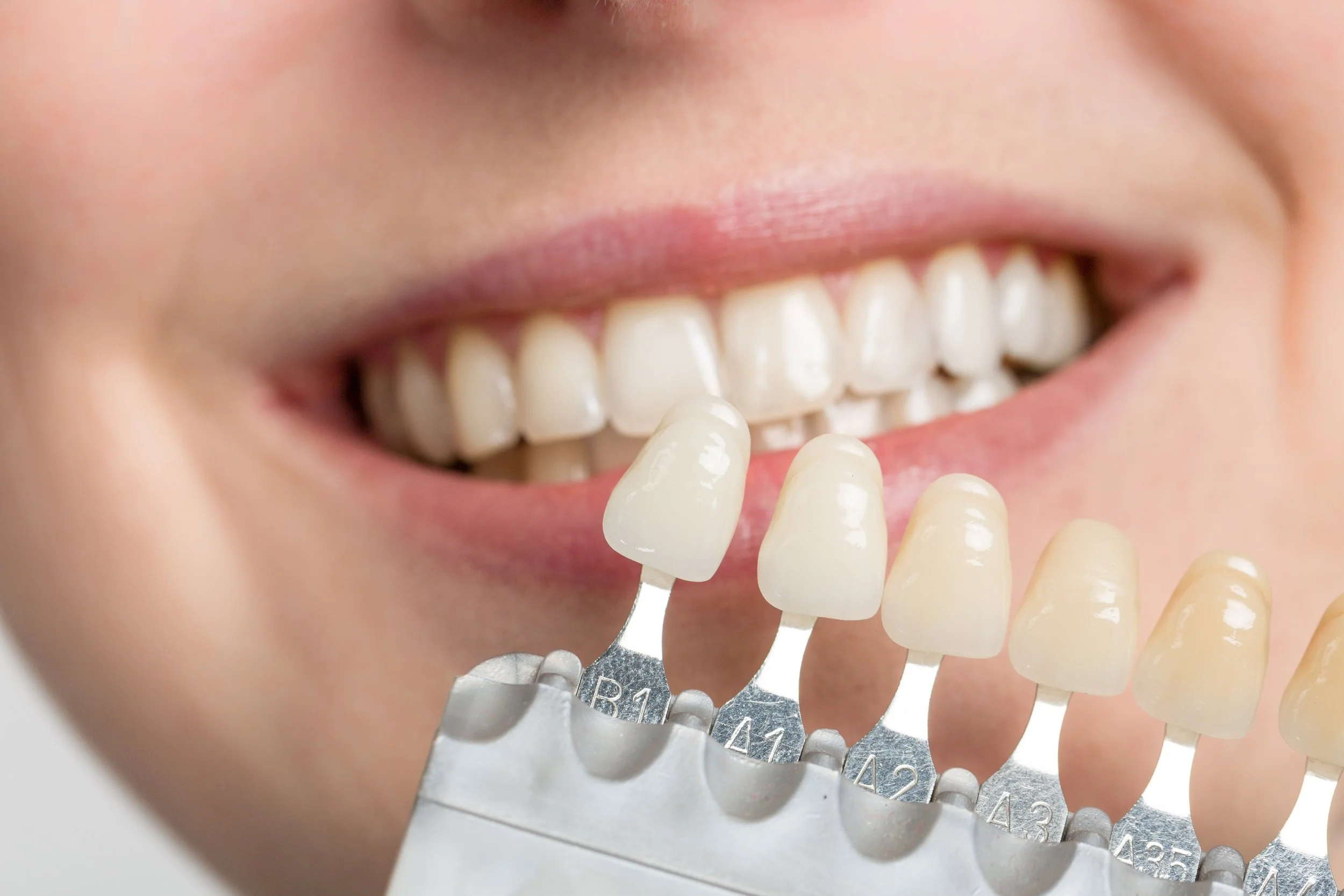 Porcelain Veneers: Your Dream Smile in Just a Few Visits