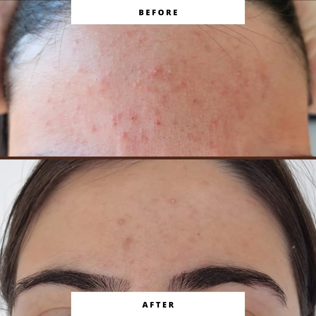 ✨Client and progress ✨

I recently worked with a client who was experiencing ongoing skin flare-ups.

I started her on a protocol which incorporated Zuanna Skincare, followed by two kinesiology sessions, each complemented with personalised home suppo