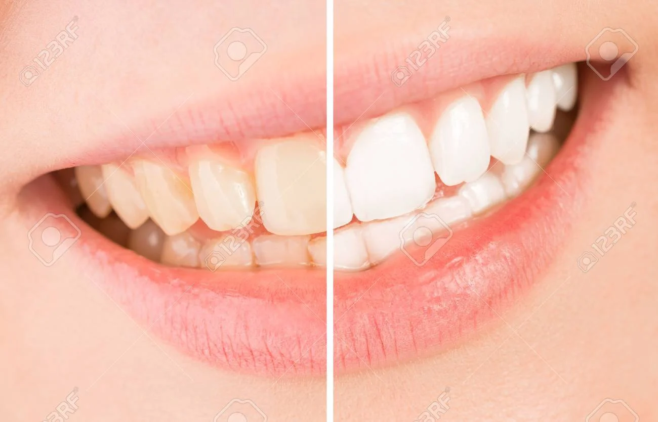 25% off Zoom whitening