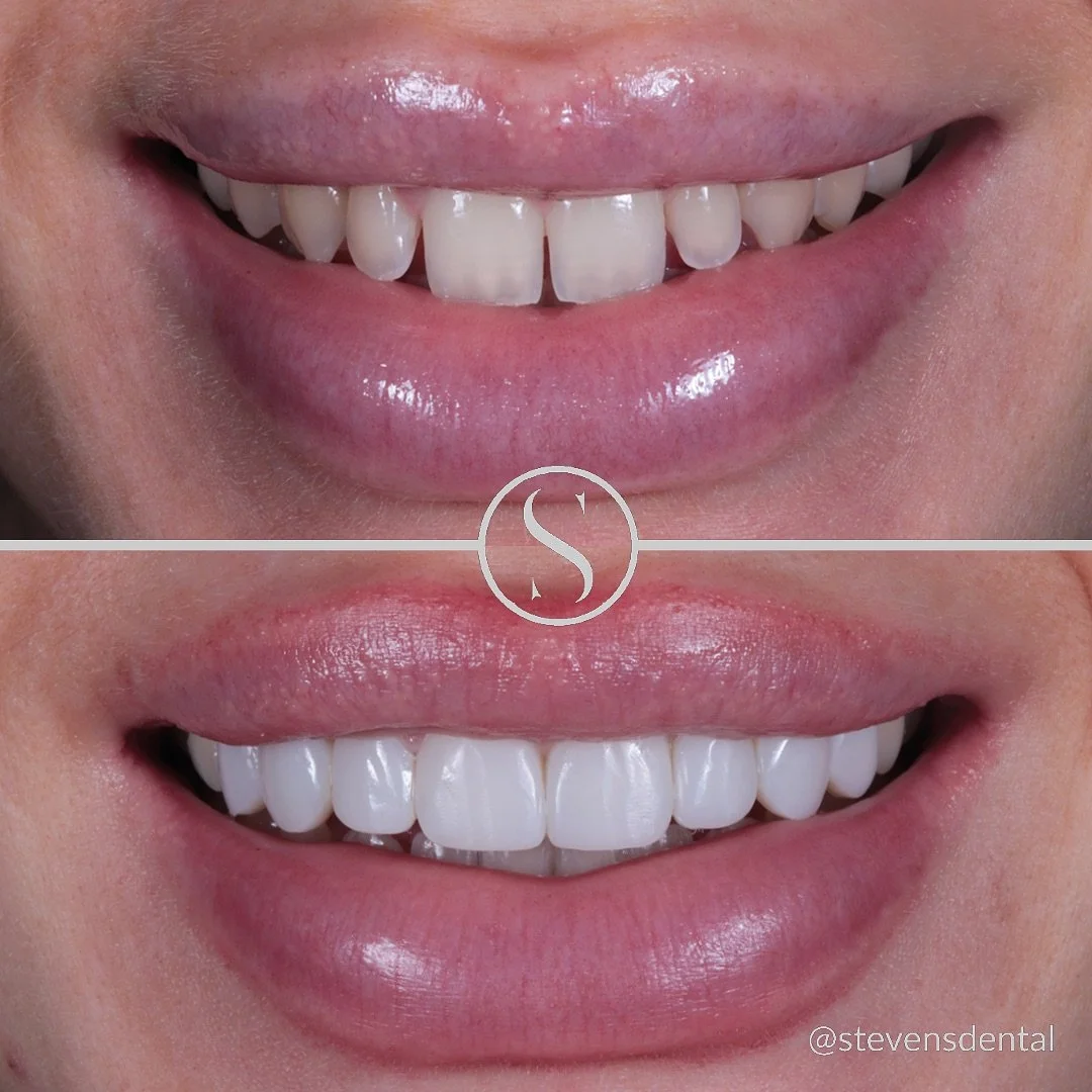 A new smile can be a great confidence booster 🦷 

Our patient didn&rsquo;t like showing her teeth when smiling, she felt they were a bit too small and had always wanted them more proportional to her facial features. 

Her teeth were carefully aligne