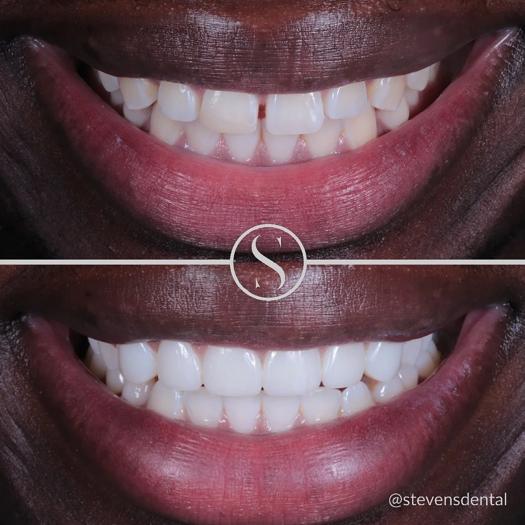 He had felt self-conscious about his smile all his life, so we changed that 🦷

Our patient wanted to close all the gaps in his teeth, fix the chip on his upper front tooth and have a brighter smile. 

He also felt his teeth looked a little small and