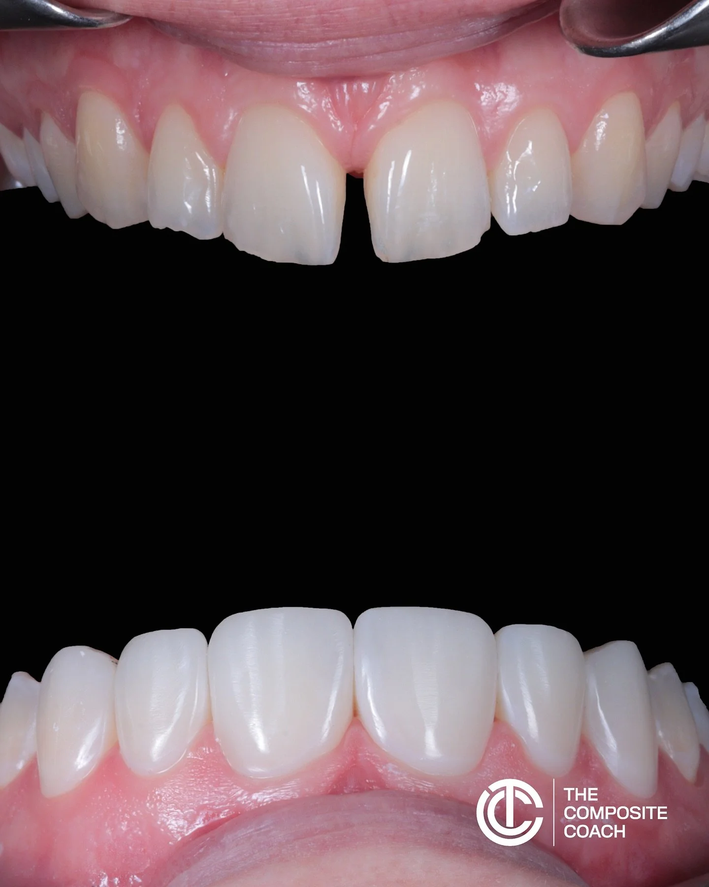 Clean margins are one of the biggest factors in how long a smile makeover lasts 

They&rsquo;re the join between the veneer and the natural tooth 🦷

If they&rsquo;re rough, uneven, or don&rsquo;t fully seal the tooth, stain can creep in, leading to 