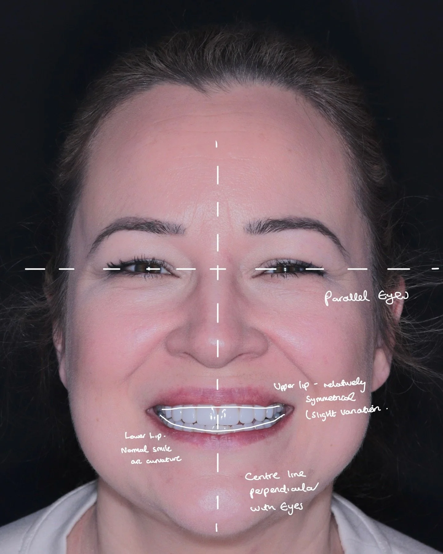 My patients often tell me they&rsquo;ve never experienced this level of detail during the planning stage of a smile makeover 🙏

Before any treatment begins, we follow a structured five-step process designed to remove uncertainty and set every case u