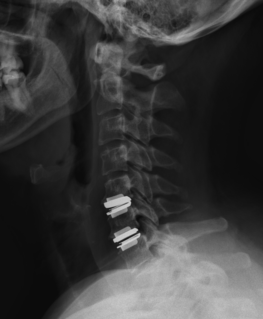 X-ray of a neck showing cervical vertebrae with three spinal implants.
