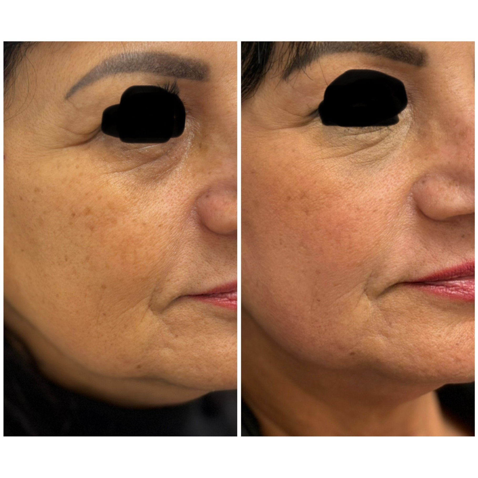 Sculptra Injections Before and After Results at YourSkinRN in Waterloo.jpg