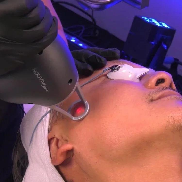 NOUVADerm BBL and IPL treatments at YourSkinRN in Kitchener-Waterloo for sun damage, rosacea, age spots, and improved skin tone and texture.
