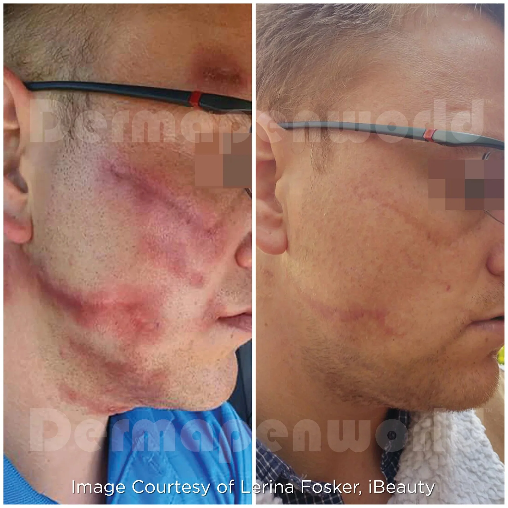 Dermapen Microneedling DP4 Treatment Before & After - Scar on Male.jpg