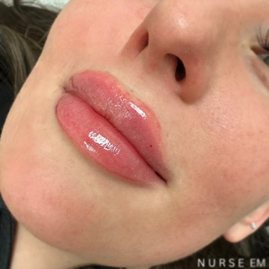 2 year lippie transformation SWIPE → to see her beforeI have treated this beautiful client’s lips twice a year for the last two years, in order to achieve this result. We have been able to add volume and shape her lips for a more hydr.jpg