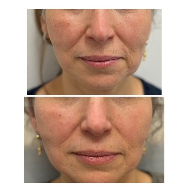 Sculptra Injections Before and After Results at YourSkinRN in Waterloo.jpg 2.JPG