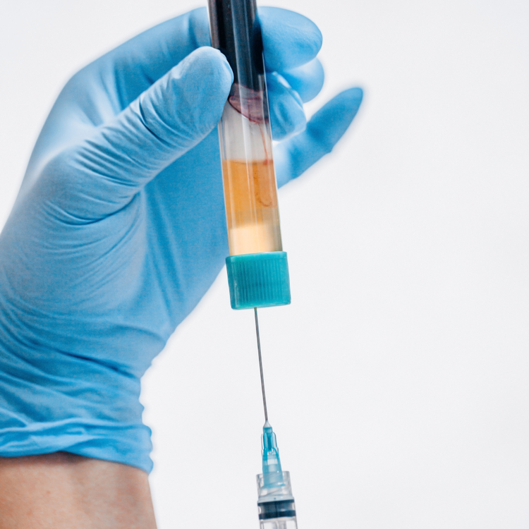 PRP injections for skin rejuvenation and hair restoration at YourSkinRN in Kitchener-Waterloo.