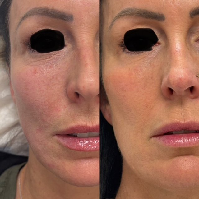 Sculptra Injections Before and After Results at YourSkinRN in Waterloo 5.jpg