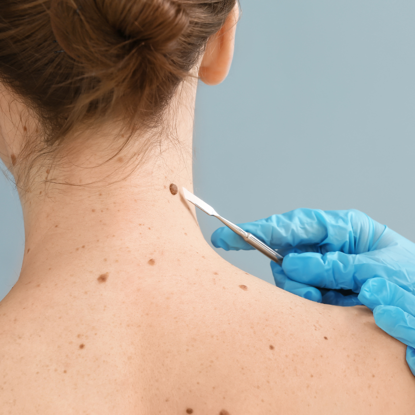 Skin Tag & Lesion Removal at YourSkinRN – Quick, effective removal of benign skin lesions and tags. Minimal discomfort with fast recovery.