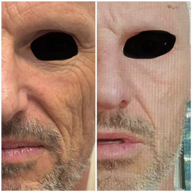 Sculptra Injections Before and After Results at YourSkinRN in Waterloo 3..jpg