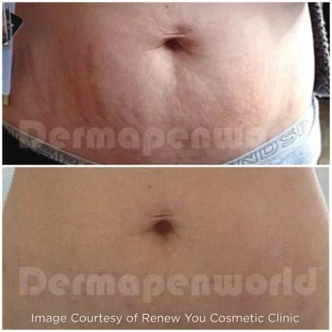 Dermapen Microneedling DP4 Treatment Before & After - Stomach Stretch marks.jpg