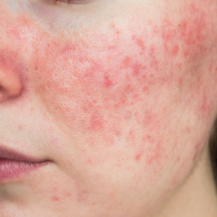 Rosacea Treatment using Aerolase NeoSkin Laser Treatment at YourSkinRN. NeoSkin by Aerolase® reduces redness, inflammation, and strengthens the skin barrier. Fast, comfortable sessions with visible results over time.
