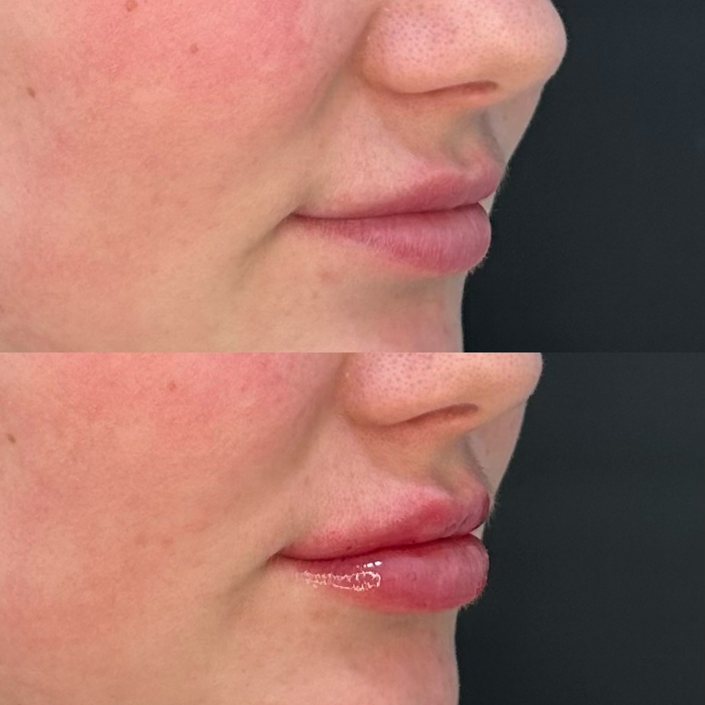 Before & Immediately After 1 Syringe of Juvederm Lip Filler at Luxus Aesthetics ππβ¨
Make an appointment by calling us at 720-275-1076 or going online to www.luxusaesthetics.com (link in bio).
Hours:
By Appointment. If you don’t see an