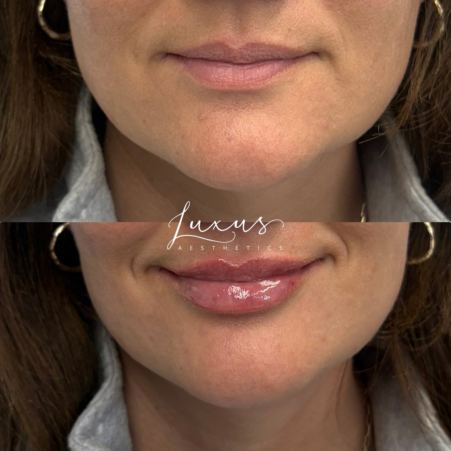 Before & After Lip Filler Using the Cannula Technique with Nurse Practitioner Laura Bodine π©πΌ‍βοΈππ
Half & Full Syringes Available!
• Full Syringe $650
• Half Syringe $400
——
Make an appointment in Colorado S