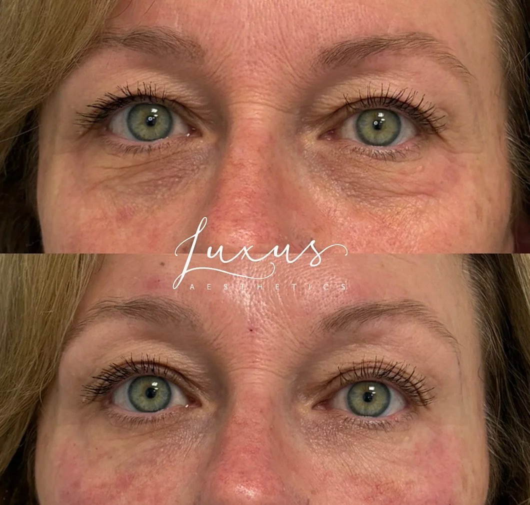 PDGF (Platelet Derived Growth Factors) immediately before and after undereye injection. You can see immediate changes in the treated area. This will continue to be enhanced with collagen and elastin stimulation over the next 6-8 weeks. One to two ses