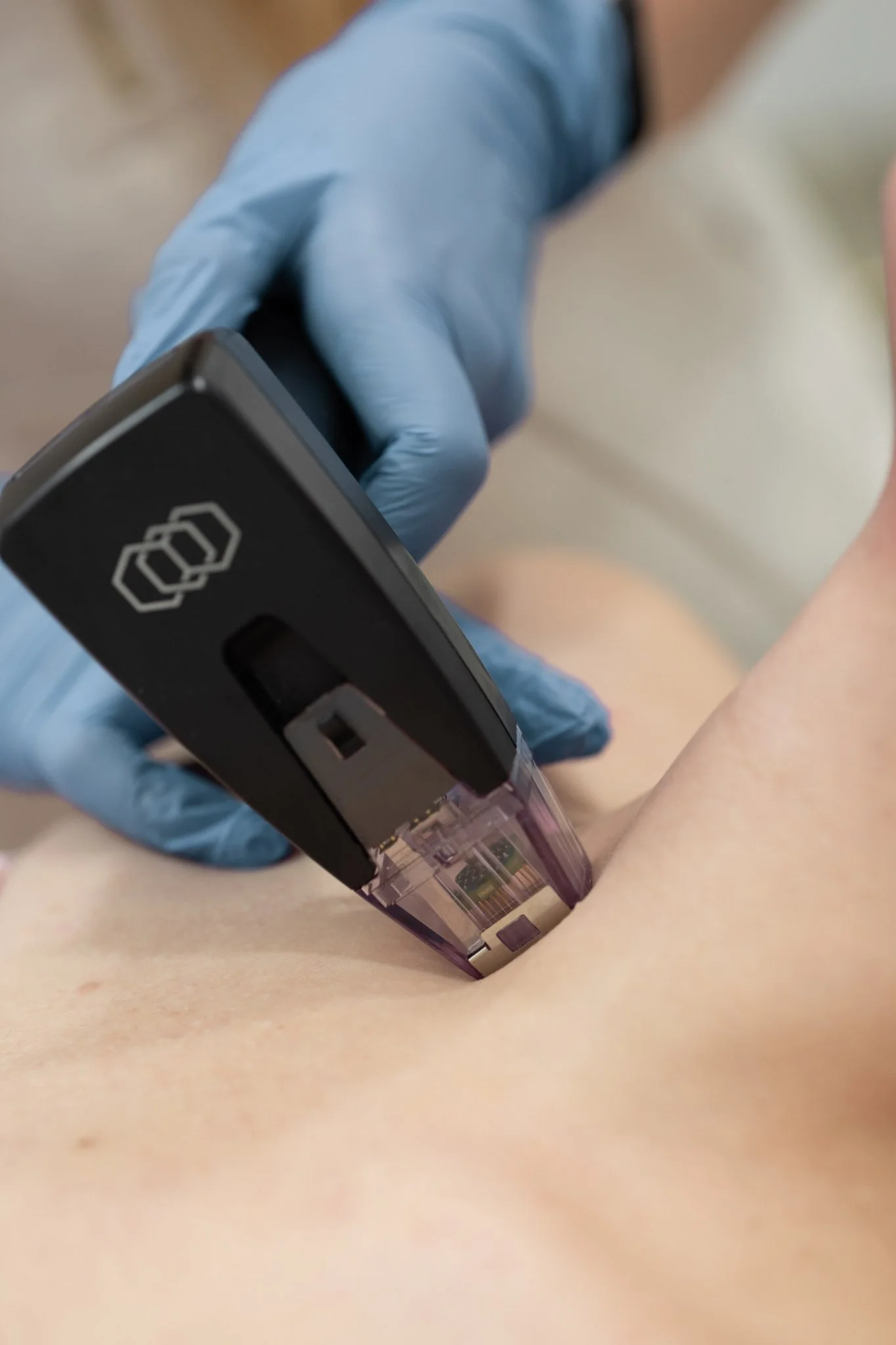 Woman receiving facial treatment with cosmetic device, performed by a professional wearing gloves.