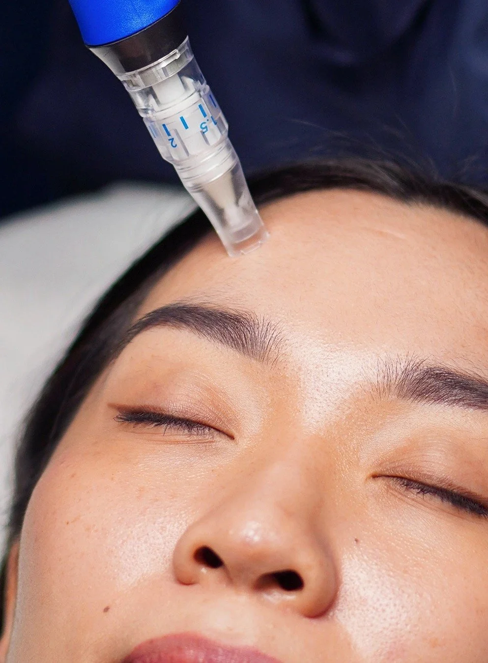 Woman receiving cosmetic treatment on face with syringe and device