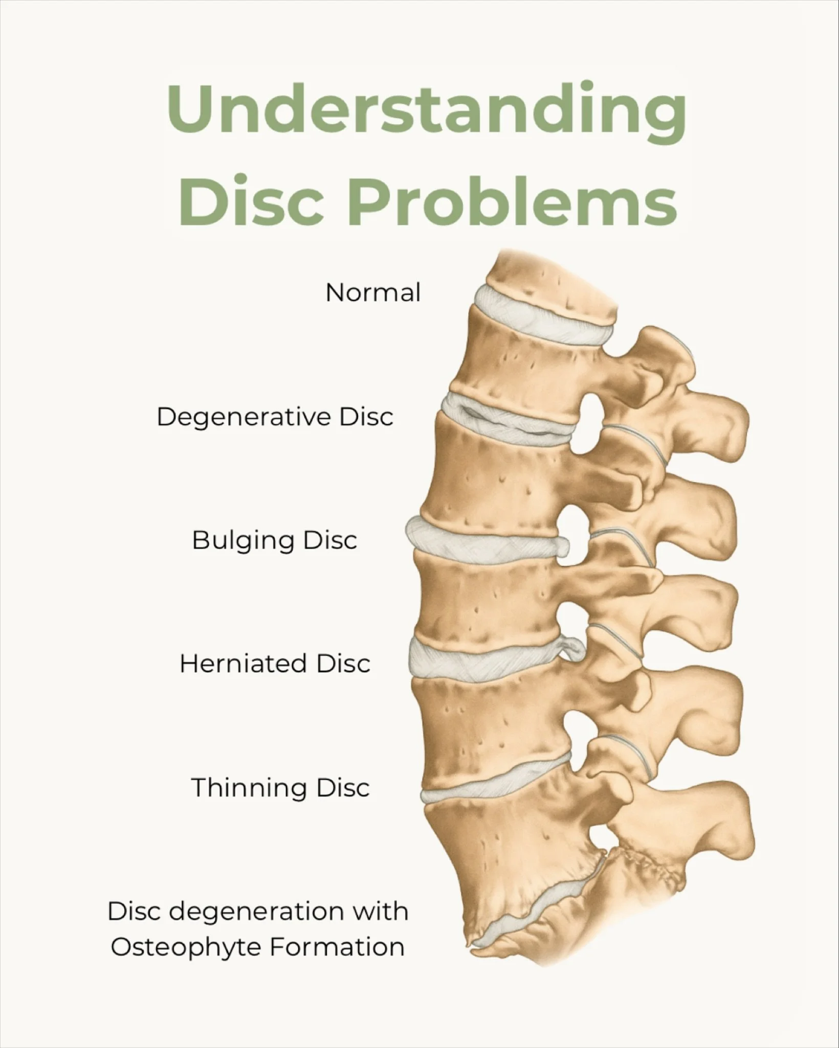 🌿 Wellness Wednesday: Understanding Disc Problems

Your spinal discs are like shock absorbers between the bones in your back. When they&rsquo;re healthy, they keep the spine flexible and protect the nerves. But sometimes, discs can become injured or