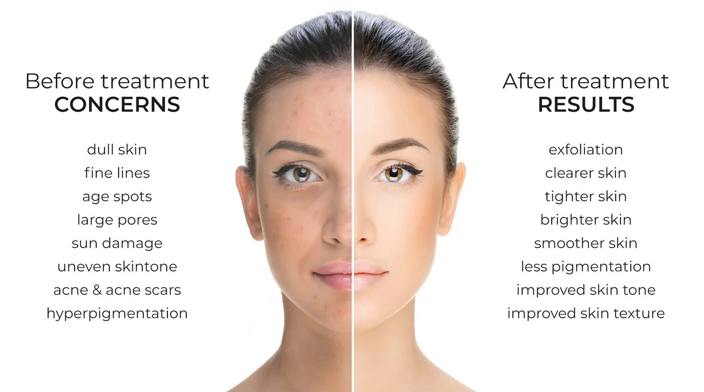 before-and-after-skin-peel.jpg