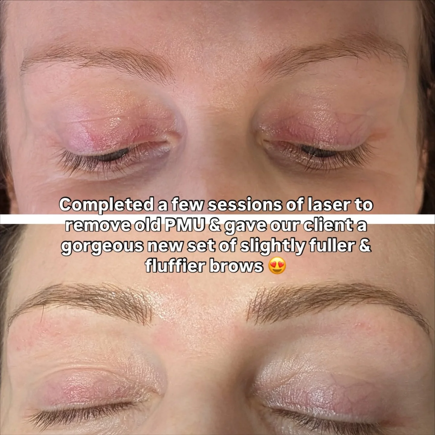 Swipe for a better look at the post-treatment results! 👉🏽

Our client came to us with old PMU she wanted to get rid of. A few sessions of laser did the trick, and we were then able to go in with new PMU to create this gorgeous set of fluffy brows.
