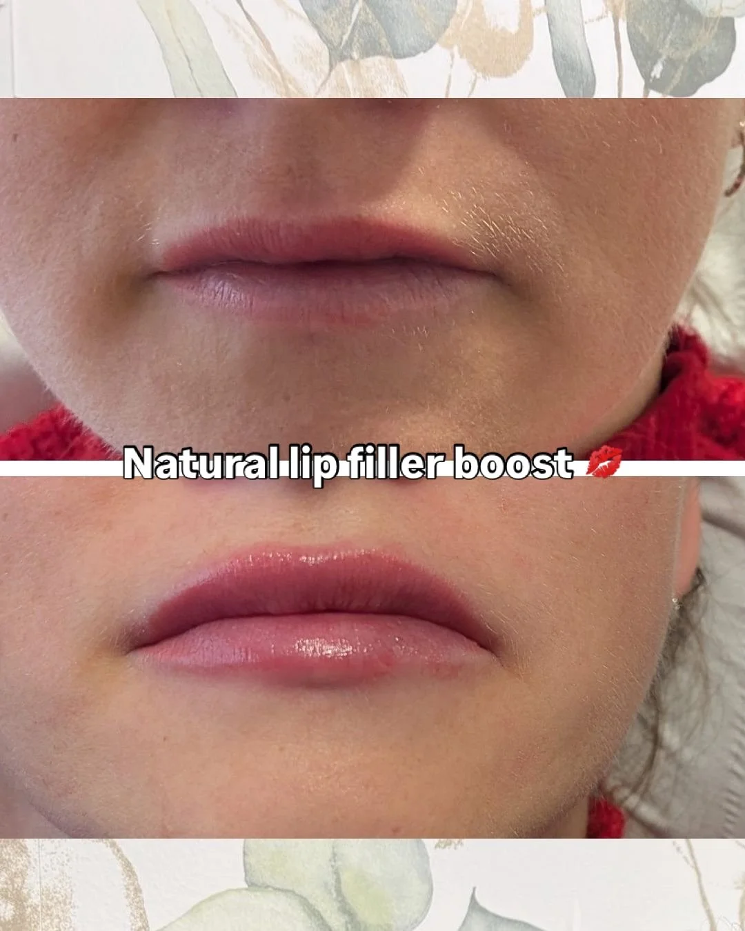Natural-looking lip filler enhancement for this lovely client! 💋 Book dermal fillers at our aesthetics clinic in Bromley via our website or 📱07590 929 099.

Lip enhancement , cheek contouring, jawline definition, chin augmentation and tear trough (